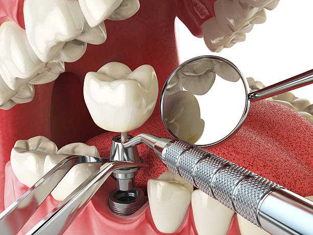 Best Urgent Tooth Repair  in Second Mesa, AZ